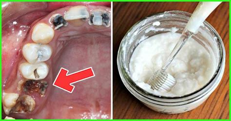 15 Amazing Home Remedies To Remove Tartar And Plaque From Teeth