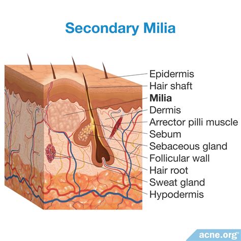 What Are Milia, and Do They Relate to Acne? - Acne.org