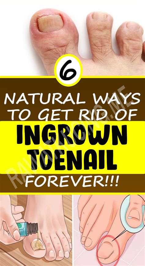 Treat Your Ingrown Toenail With These 6 Natural And Homemade Remedies - exstremboard