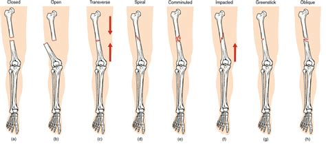 Fractures: Bone Repair | Anatomy and Physiology I
