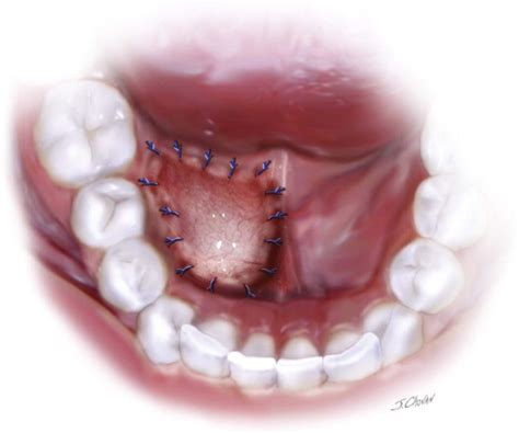 Marsupialization | Pocket Dentistry