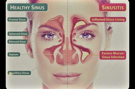 Does Sinus Infection Cause Pressure In Ears at Adele Castillo blog