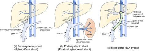 Schema of meso-Rex bypass versus portosystemic shunt. a Porte-systemic ...