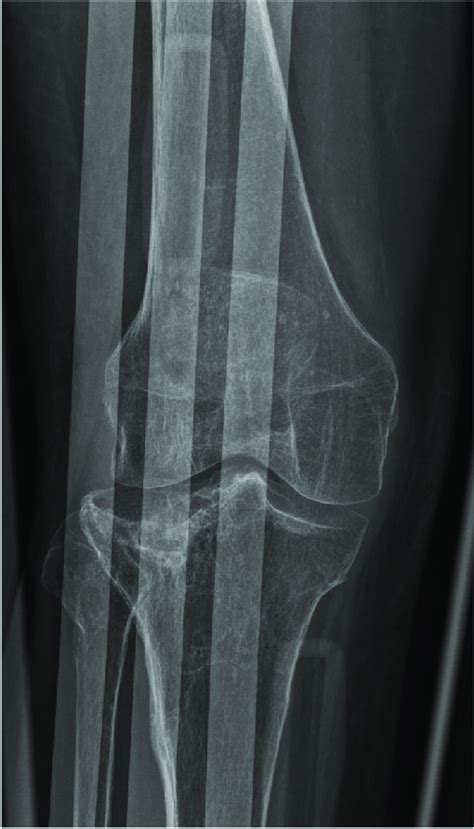 Nondisplaced Tibial Plateau Fracture Recovery