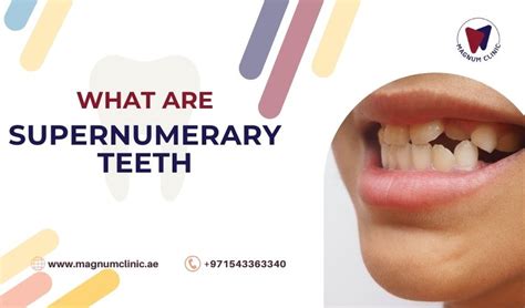 What are supernumerary teeth, syndrome, causes, extraction