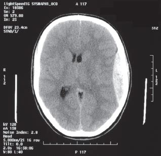 CT scan demonstrating left extradural haematoma. | Download Scientific ...