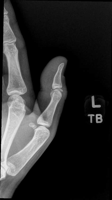 OrthoDx: Pain in Thumb - Clinical Advisor