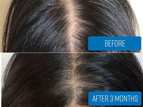 A Closer Look At Biotin For Hair Growth Results | Lewigs