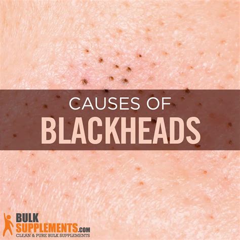 Blackheads. Bye-Bye. Easily Treat and Prevent Blackheads.