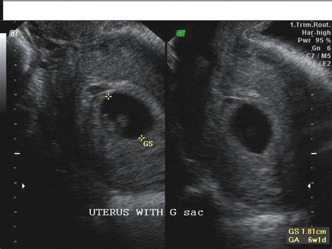 Corpus Luteum Ultrasound