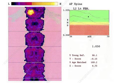 Bone densitometry result - Stock Image - C004/0341 - Science Photo Library