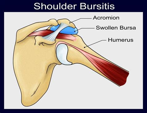 shoulder-bursitis – Neo Orthopaedic Clinic