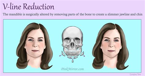 Facial fat – What kind of corrective procedure or surgery is right for ...