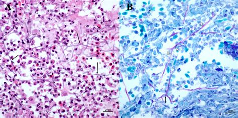 Histopathological photomicrographs of fungal hyphae within lesions of... | Download Scientific ...