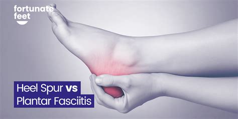 Heel Spur vs Plantar Fasciitis - Similarities and Differences ...