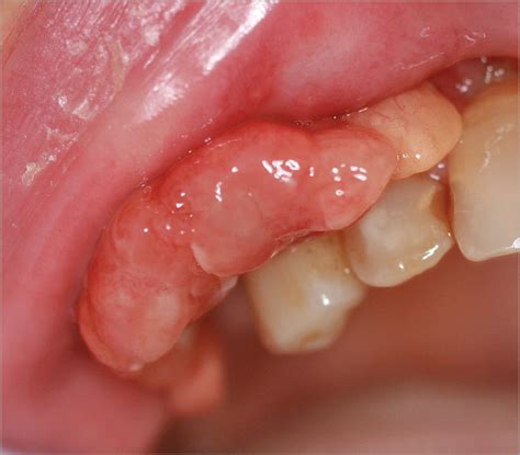 An Intraoral Mass Associated With Myelodysplastic Syndrome | Oncology | JAMA Oncology | The JAMA ...