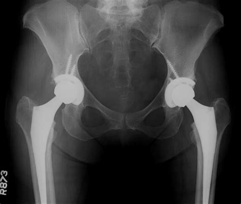 Total hip replacement in a middle-aged female patient with bilateral hip osteoarthritis | St ...