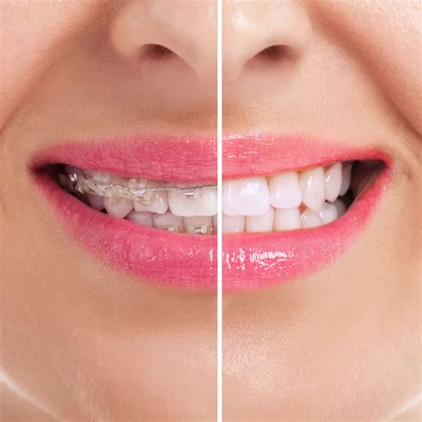 Orthodontics (Braces) - Family Dental Center