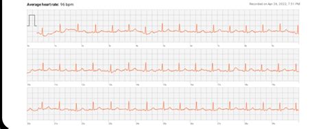 My Watch Detected Afib. Is this true? : ReadMyECG