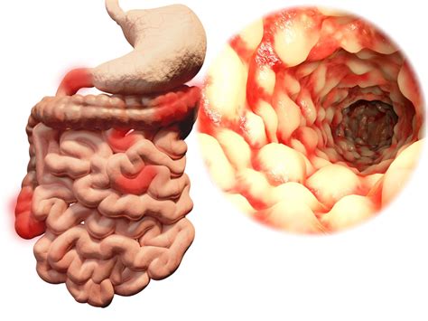 Inflammatory Bowel Disease - Arise Infusion