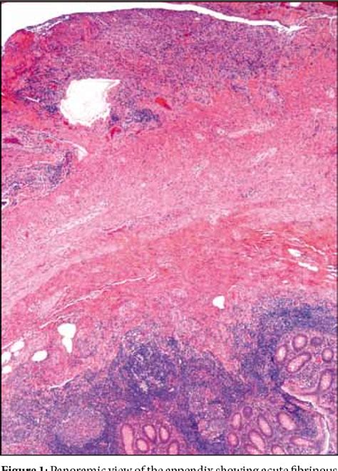 Figure 1 from Vernix Caseosa Peritonitis: Report of Two Cases / Verniks ...