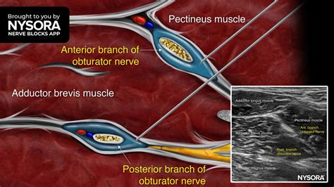 Tips for an Obturator Nerve Block- Distal Approach - NYSORA | NYSORA