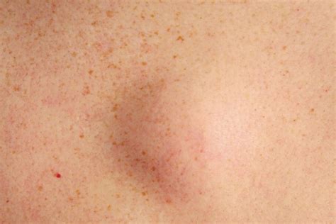 8: Fatty Deposits (Lipoma) - 10 Grossest Things in Your Body Right Now | HowStuffWorks