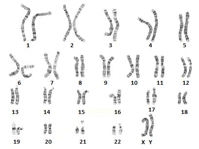 Patau's Syndrome (Trisomy 13)