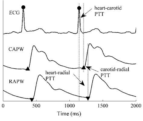 Simultaneously measured ECG, carotid and radial arterial pulse ...