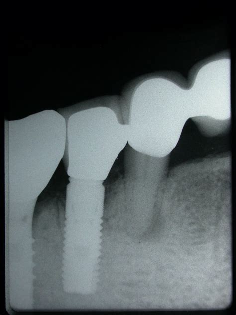 A Periodontal Expert: Astra® Dental Implant System