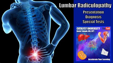 Lumbar Radiculopathies | Presentation, Diagnosis, & Special Tests - YouTube