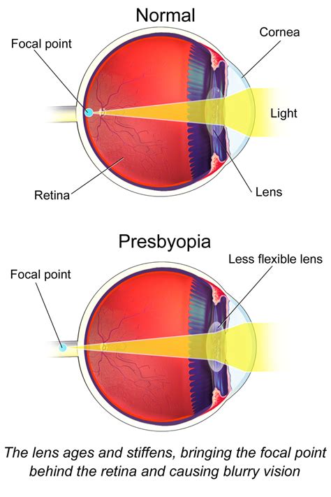 Midtown Optometry - Treating Presbyopia with (Digital) Progressive Lenses