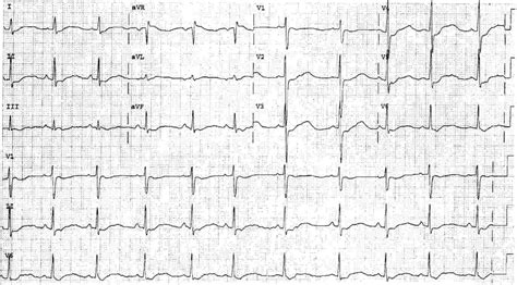 Hypokalemia Hyperkalemia Ecg