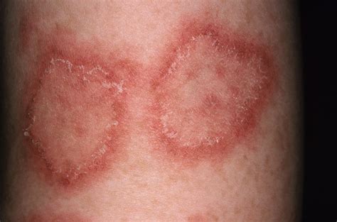 Atacicept Effective for Systemic Lupus Erythematosus Activity, Severity - Rheumatology Advisor