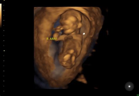 Microphthalmia with limb anomalies with fetal teratoma | IJWH