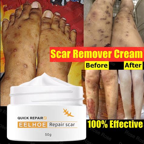 EELHOE old Scar Remover for legs 50g peklat remover acne Surgical ...