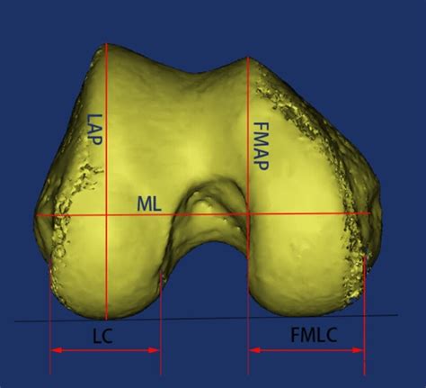 The image is a three-dimensional schematic of the femoral condyle... | Download Scientific Diagram