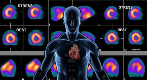 Nuclear Stress Test | Centrelake Imaging