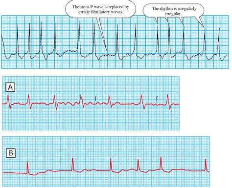 Atrial Fibrillation Atrial Fibrillation Vs Atrial Flu - vrogue.co