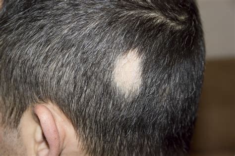 Alopecia Areata: Symptoms, Causes & Treatment - Tua Saúde