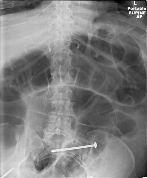 Ileus and small bowel obstruction - Cancer Therapy Advisor