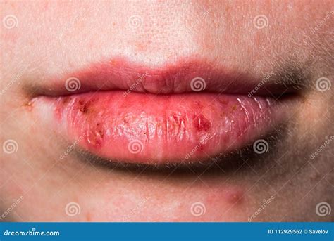 Damaged female lips macro stock photo. Image of dermatology - 112929562