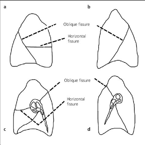 Lung Anatomy Fissures