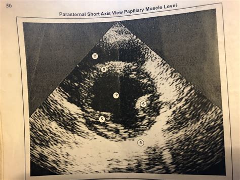 Parasternal Short Axis View Papillary Muscle Level Diagram | Quizlet