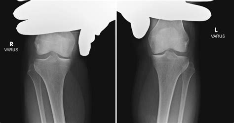 —Varus stress radiographs demonstrating increased lateral compartment... | Download Scientific ...