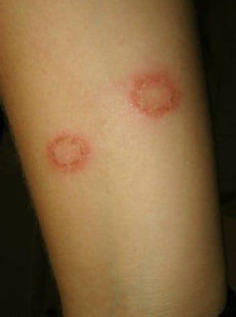 Tinea Corporis - Pictures, Treatment, Causes, Symptoms - HubPages