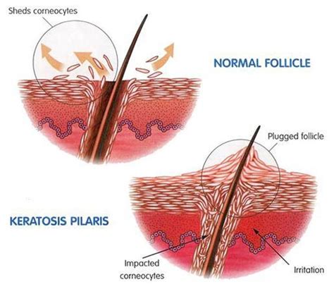 KPCare+ Keratosis Pilaris Kaffee-Peeling