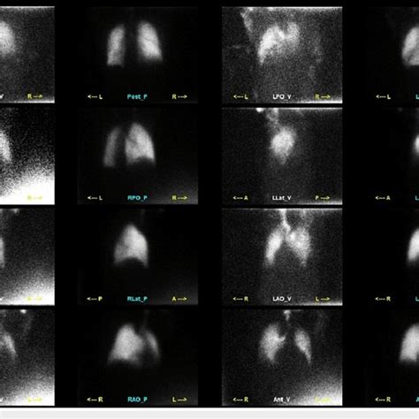 Nuclear medicine lung ventilation-perfusion scan shows matching ...