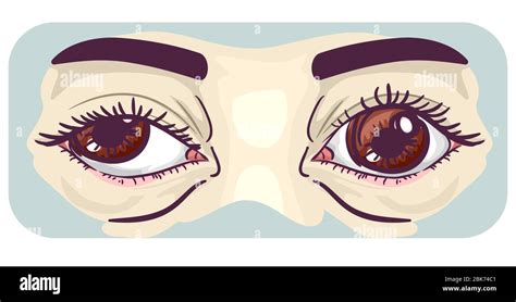 Illustration of Amblyopia or Lazy Eye with One Eye Looking Outward ...