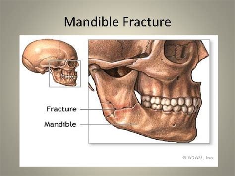 Facial Injuries Sports Med II Mandible Fracture Cause